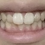 나 <b>앞니</b> ㅈㄴ큰데 어카냐?ㅋㅋㅋ