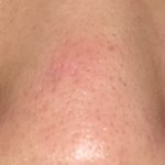 얘들아 나 <b>콧등</b>쪽에 피지낭종?같이 생겼는데