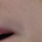 <b>여드름</b> 개징그러워