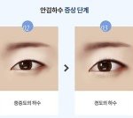 [댓글부탁해] 얘들아 나 <b>눈매</b>교정 해야겠지?