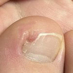 [댓글부탁해] 나 <b>내성</b>발톱 제거하러 가는데