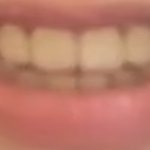 치아<b>미백</b> ㄹㅈㄷ임 효과