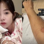 '둘째 임신' 김보미, 피 5통 뽑아 피멍... "더 찌를 곳...