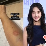 팔에 주사 자국 가득 "피 5통이나 뽑네"…입원 <b>이은</b> 일상 공개