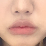 얘들아 나 <b>턱</b><b>필러</b>+입꼬리<b>필러</b> 맞을까말까 ㅠ