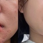 [드루와] 여드름피부 수딩크림 추천해줌