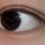 나 <b>쌍수</b>하면 잘 될 눈이야?