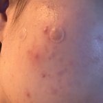 [댓글부탁해] 결혼준비 <b>경락</b> 피부 뒤집어짐