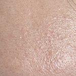 [방탈죄송] 이마 <b>좁쌀</b> 여드름 없애는 방법