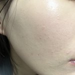 [19] 얘들아 나 <b>피부</b>ㅜㅜ (혐주의)