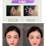 이 귀<b>필러</b> 전후 사진