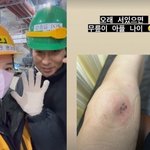 김동성 아내 인<b>민정</b>, 안타까운 근황…심각한 다리 상태