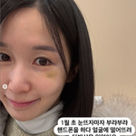 투병' <b>초아</b>, 얼굴에 시퍼런 멍.."타박상, 부어올라 눈물"