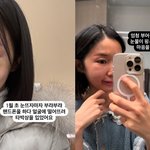 크레용팝 출신 <b>초아</b>, 얼굴 멍든 근황 공개…"타박상 입었어요"