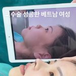 와 코<b>수술</b> ㅈㅉ 잘됨