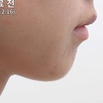 나 <b>무턱</b>되고 싶음