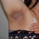 뚱뚱한 사람들 보면 겨드랑이가 엄청 검어지고 흑색<b>가시</b>증 생기잖아