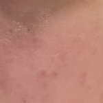 혐주의) 여드름 어떻게해야돼 하 ㅠㅠ