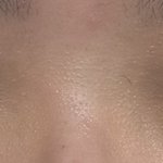 나 꼬막눈 때문에 너무 스트레스 받는데 앞트임+<b>듀얼</b>트임 에바일까