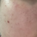 혐주의) 여드름 어떻게 해야돼 ㅠㅠㅠㅠ 도와줘