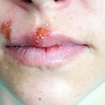[너무화가나] 헤르페스 옮긴 전남친 고소