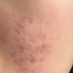 [댓글부탁해] 여드름 <b>곰보</b>흉터 어떡하지 고1인데 제발 도와줘.....