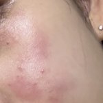 와 나 피부가 너무 약한가봄