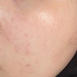 이거 여드름 <b>색소</b>침착이야?