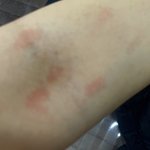 오늘 레이저<b>제모</b> 처음 받고왓는데 질문 잇어?