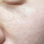 인플루언서 뷰티기계로 인해 피부가 손상되었습니다!