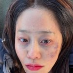 [모두드루와] 고현정, 큰 수술 받은 후 흰머리+멍 투성이 얼굴...