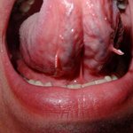 [혐오주의] 혀 아래있는 <b>더듬이</b>2개