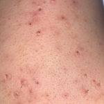 혹시 나처럼 등<b>드름</b> 심한사람 있어??