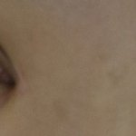 나 쌍수 절개 18일<b>차임</b>