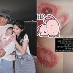 이지훈아야네, 딸 <b>원인불명</b> 질환에 결국 오열..충격 피부 상태