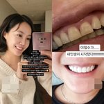 "새 인생 시작" 고은아, 심각한 안면 부상 치료 후..밝은...