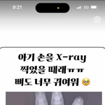 손 <b>엑스</b>레이 사진이 너무 무서움