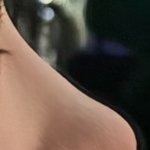 [댓글부탁해] 코성형 한<b>달차</b>인데 붓기 언제 빠질까요?