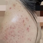 이런 피부도 회복 가능할가요?? 도와주세요..