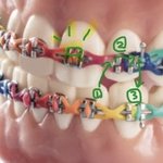 교정기 <b>고춧가루</b> 끼면