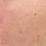 모공이랑 <b>요철</b> 이번에도 해결 안되면 진짜 병원감(피부약혐..)