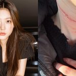 김새론 병원비 500도 보험 안 돼서 소속사가 <b>대납</b>했다는 거 실화냐