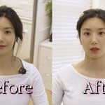 권은비, 적나라한 시술 전후 공개 "내가 이렇게 생겼었다니"...