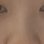 근데 콧볼<b>축소</b>하면