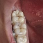 충치 <b>신경치료</b>까지 해야하냐