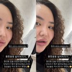 '홍진영 언니' 홍선영, 입술 필러 맞아 울퉁불퉁해졌는데.."녹이고...