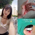 신수지, <b>피범벅</b> 손 공개 "귀국 후 병원行→ 봉합 수술"