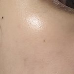 이런 <b>색소</b>침착 어케 없앰..