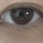 [댓글부탁해] 앞트임 <b>흉터</b> 티 많이 나??