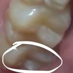 [댓글부탁해] 약혐) 나 여기 <b>충치</b>같음?